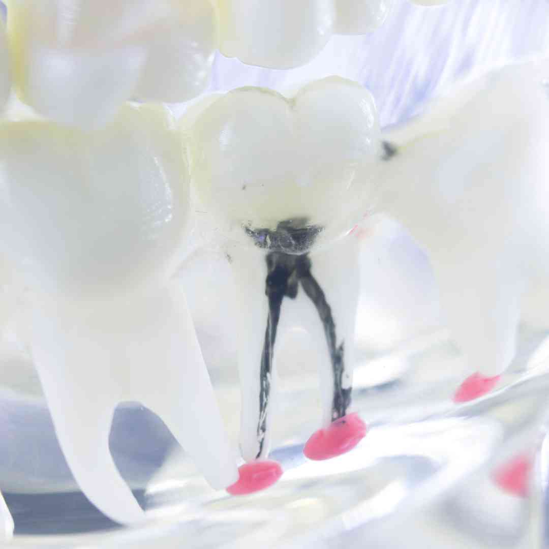 Root Canal