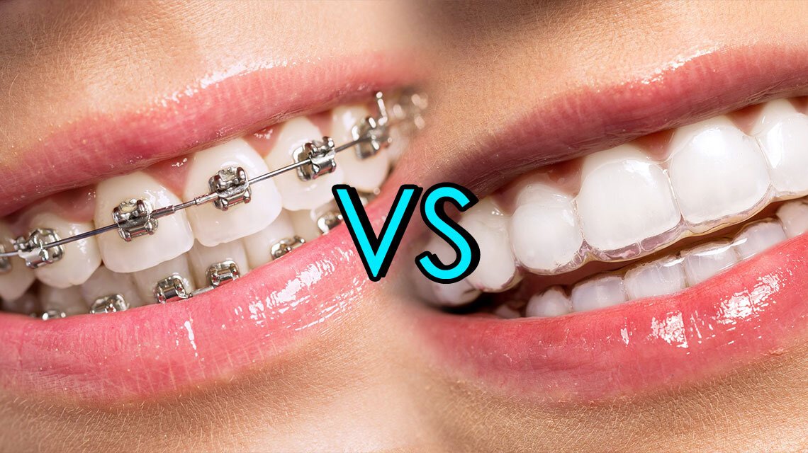 invisalign-vs-braces
